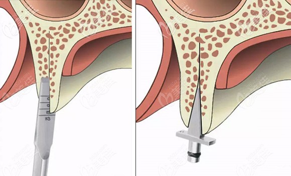 骨劈開手術(shù)過程圖 骨劈開手術(shù)過程圖
