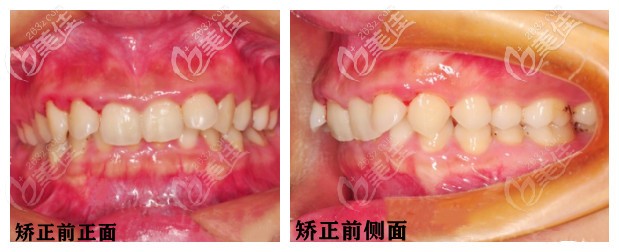 矯正前正面和側(cè)面牙齒情況 矯正前正面和側(cè)面牙齒情況