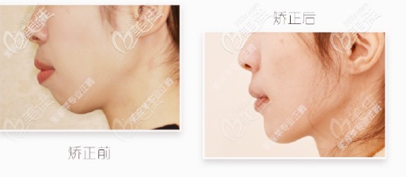 郭淑蘋院長的矯正案例 郭淑蘋院長的矯正案例