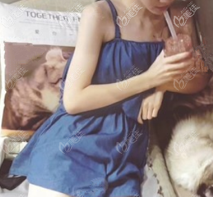 威塑腰腹環(huán)吸恢復(fù)期也不算太久，這是我兩個多月的樣子