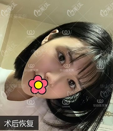 長(zhǎng)曲線下頜角截骨四個(gè)月效果 長(zhǎng)曲線下頜角截骨四個(gè)月效果