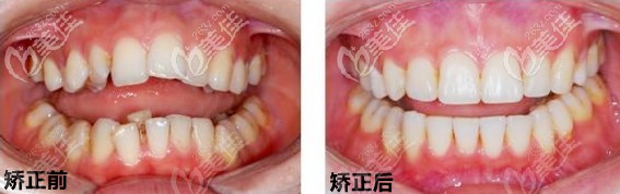 矯正前后對(duì)比