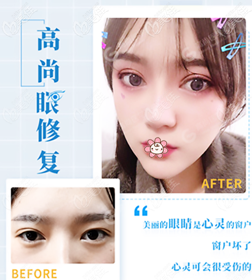 余文林醫(yī)生雙眼皮修復技術怎么樣 余文林醫(yī)生雙眼皮修復技術怎么樣