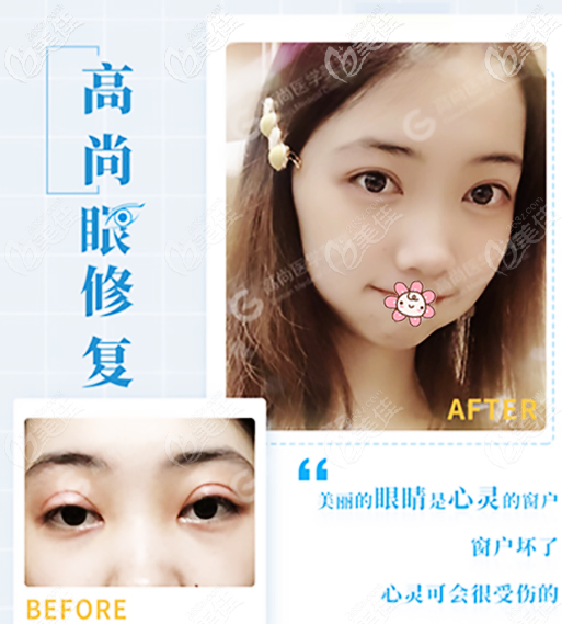 廣州高尚余文林雙眼皮修復怎么樣 廣州高尚余文林雙眼皮修復怎么樣
