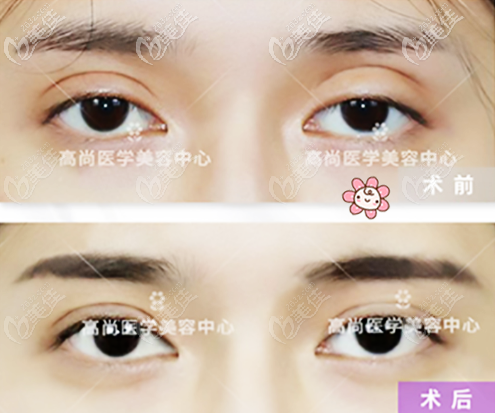 余文林雙眼皮修復療效圖 余文林雙眼皮修復療效圖