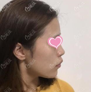 注射隆鼻術(shù)前照 注射隆鼻術(shù)前照