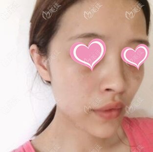 注射隆鼻術(shù)后第2天 注射隆鼻術(shù)后第2天