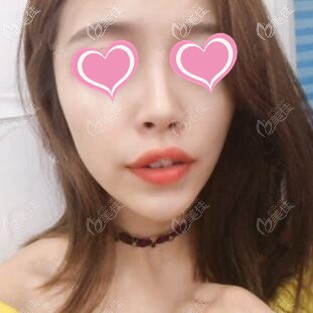 注射隆鼻術(shù)后15天照 注射隆鼻術(shù)后15天照