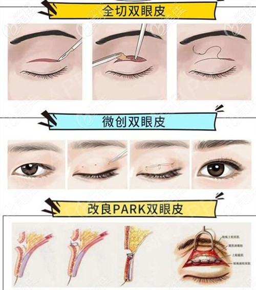 玉林華美雙眼皮方法