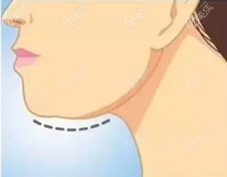 北京做下頜緣吸脂的價格是多少?本月在麗都做下頜緣吸脂有優(yōu)惠