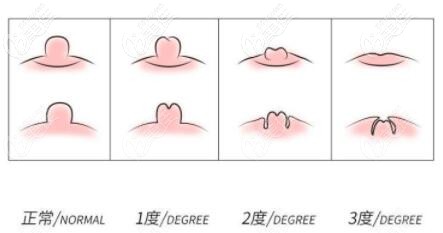 乳頭凹陷的類型程度