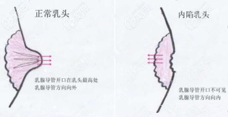 20多歲女生有乳頭內(nèi)陷這正常嗎