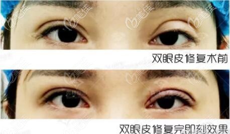 雙眼皮修復(fù)前后真人對比圖片 雙眼皮修復(fù)前后真人對比圖片