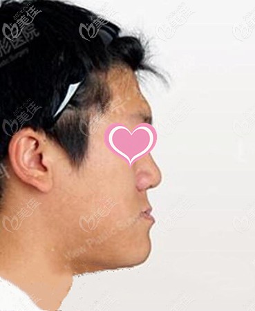 地包天矯正手術(shù)前 地包天矯正手術(shù)前