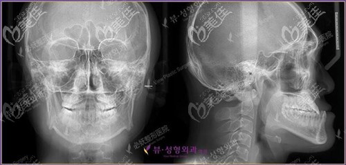 骨性凸嘴拍片效果 骨性凸嘴拍片效果