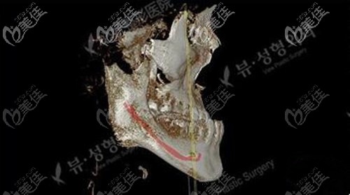 雙鄂手術(shù)前拍片效果 雙鄂手術(shù)前拍片效果