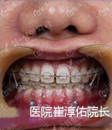 骨性地包天手術(shù)后牙齒矯正 骨性地包天手術(shù)后牙齒矯正