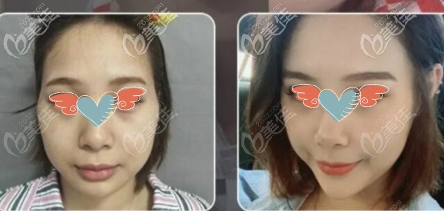 面部脂肪加減法真實(shí)案例術(shù)前術(shù)后對(duì)比效果圖