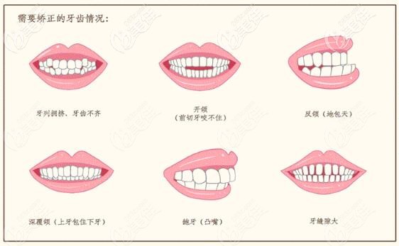 合肥美奧口腔招募對(duì)象