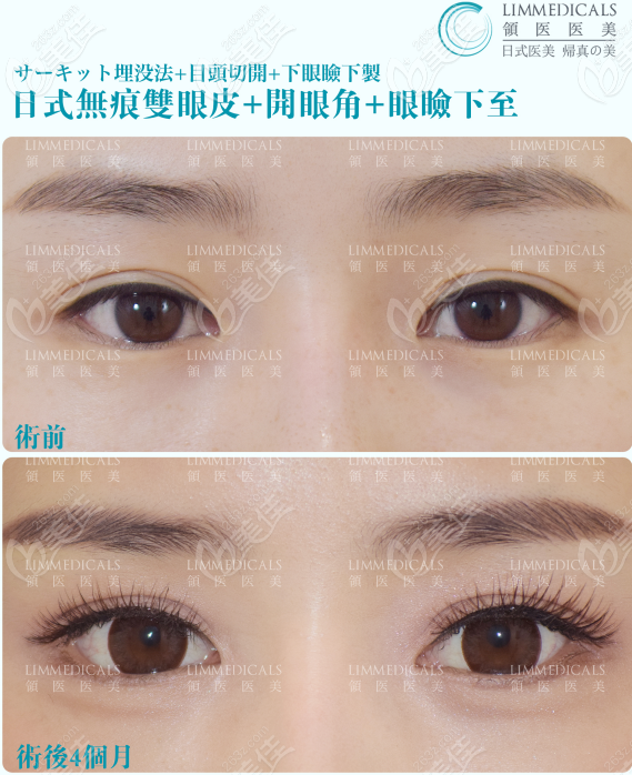 好神奇!看完日式無痕雙眼皮7天恢復(fù)過程圖發(fā)現(xiàn)真的一周就恢復(fù)自然了