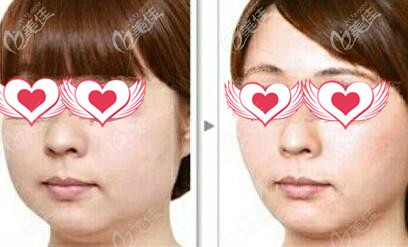 去頰脂墊前后對(duì)比照