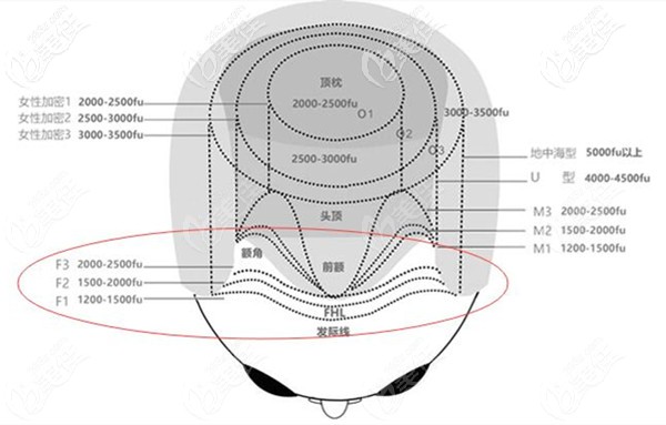 女生發(fā)際線高需要種植的毛囊數(shù)量