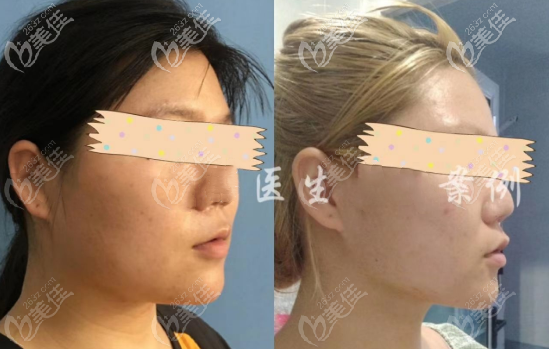 重慶軍美面下部吸脂案例