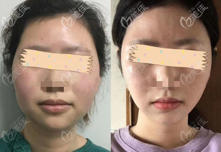 重慶軍美面部雙下巴吸脂術(shù)后半年對(duì)比效果圖