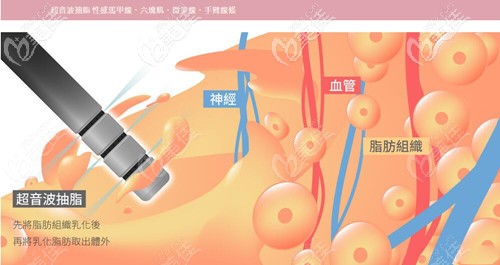 韓國維摩震動吸脂法