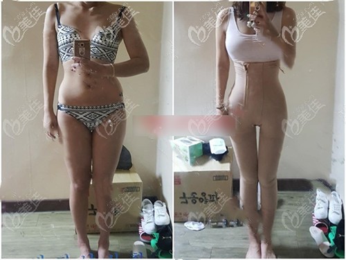 韓國維摩大腿吸脂前后對比案例