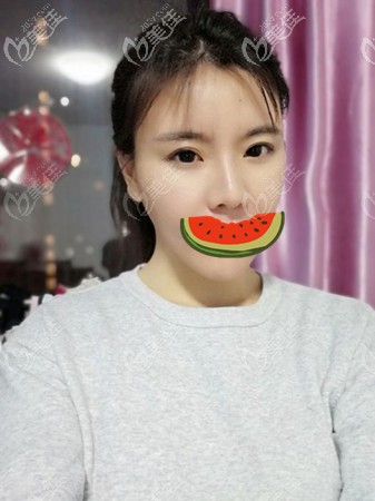 快看生圖!在寧夏華美做的耳軟骨墊鼻尖恢復(fù)后鼻頭沒吸收還賊軟