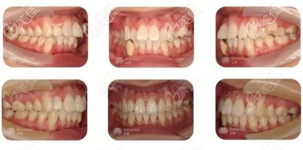 正雅s8成功矯正案例