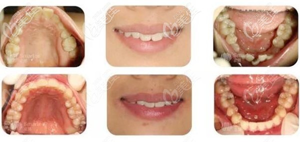 正雅隱形矯正案例