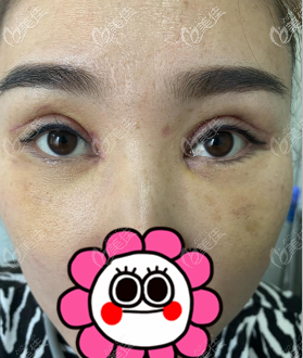 內(nèi)眼角開(kāi)大了修復(fù)后的第5天的圖片 內(nèi)眼角開(kāi)大了修復(fù)后的第5天的圖片