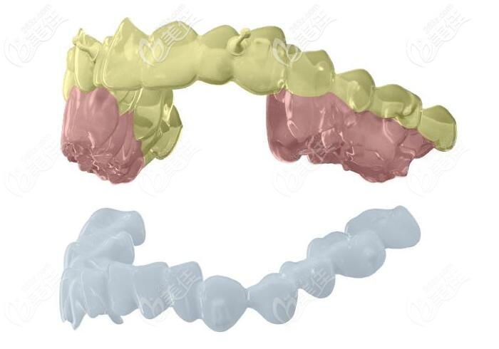 國產(chǎn)正雅s8隱形牙套價(jià)格
