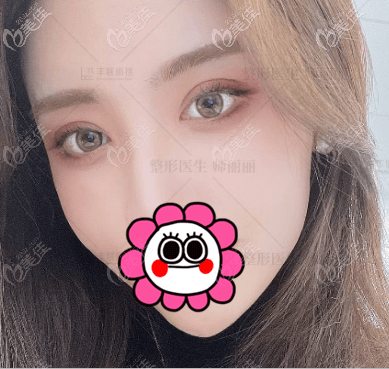 師麗麗做眼修復(fù)怎么樣?領(lǐng)略她的雙眼皮寬窄不一修復(fù)技術(shù)還是挺靠譜的