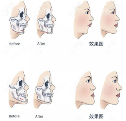 <!--<i data=20240703-sp></i>-->正頜手術(shù)根據(jù)不同問(wèn)題制定不同手術(shù)方案