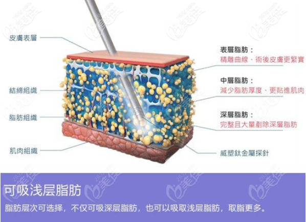 各個(gè)不同層次分區(qū)取脂