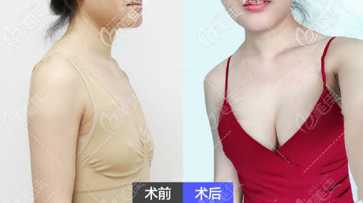 點(diǎn)對(duì)點(diǎn)自體脂肪豐胸效果圖