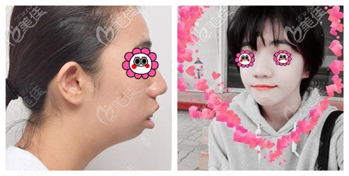 韓國(guó)EU整形的雙顎手術(shù)案例