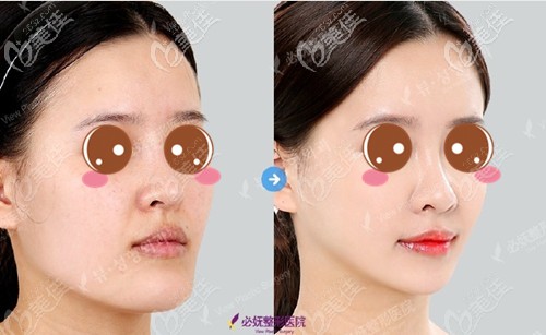 韓國(guó)必嫵雙顎手術(shù)案例