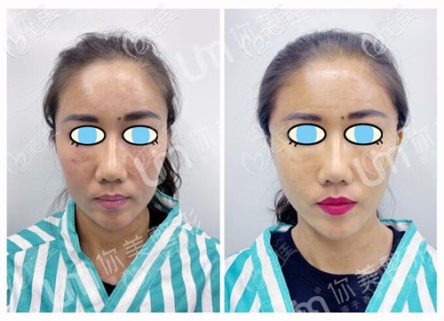 微提id小膠片面部提升案例