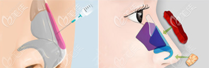 筋膜外衣包裹技術(shù)