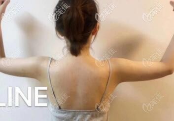 在韓國artline醫(yī)院做手臂吸脂效果真不錯(cuò)，關(guān)鍵價(jià)格還挺便宜的！