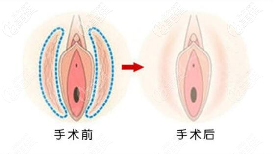 下身外陰撕裂縫合前后效果對(duì)比圖 下身外陰撕裂縫合前后效果對(duì)比圖