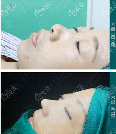 常輝彥醫(yī)生做的隆鼻實(shí)例