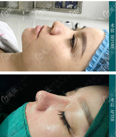 廣州荔灣常輝彥做鼻子怎么樣