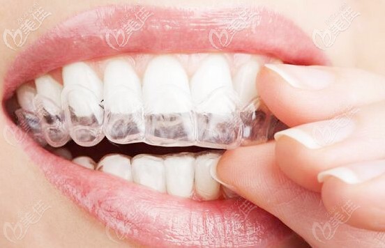 隱形牙套
