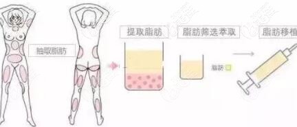 自體脂肪移植填充過(guò)程