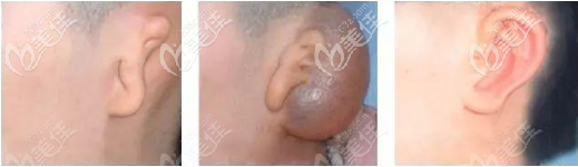 耳再造手術(shù)過(guò)程